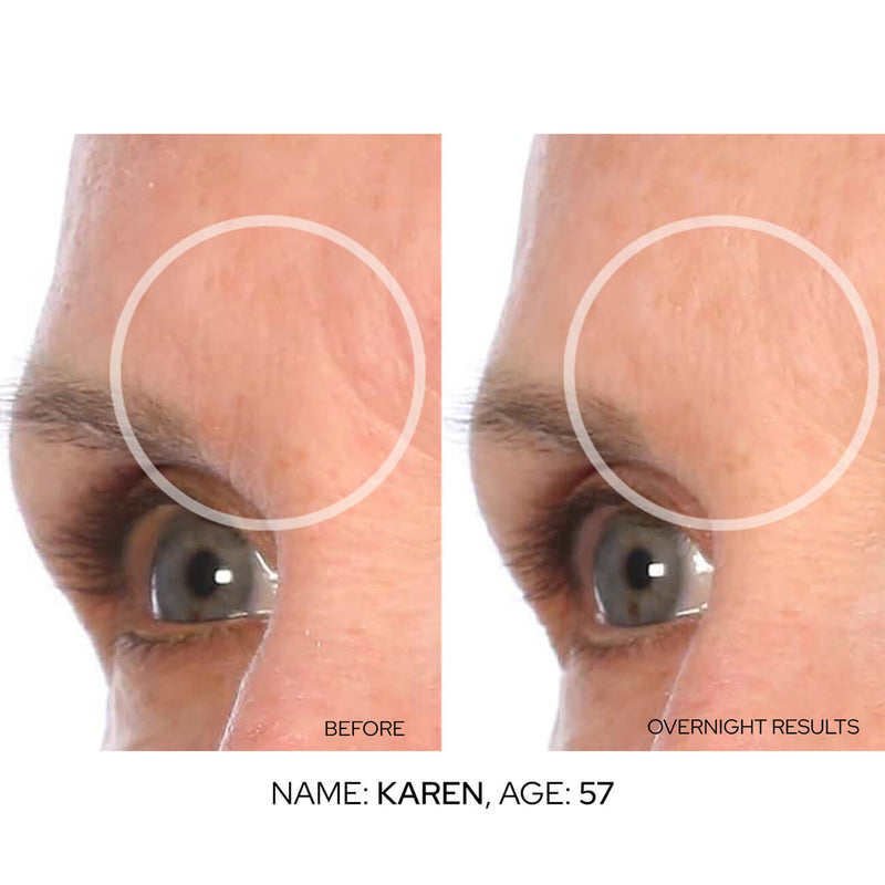 SmoothLift Forehead Patches