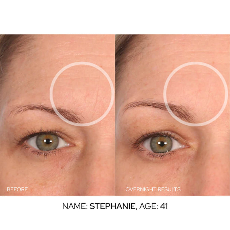 SmoothLift Forehead Patches