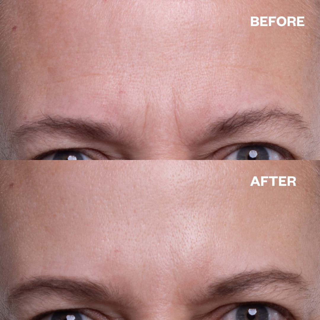 SmoothLift Forehead Patches