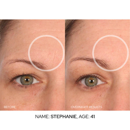 SmoothLift Forehead Patches